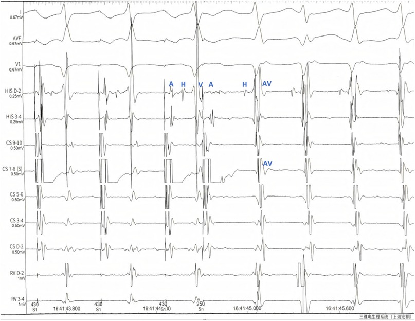 Medical electrophysiology tracing showing various leads, including I, AVF, V1, HIS, CS, and RV, with distinct waveforms. The letters A, H, and AV mark specific points on the tracing, indicating electrical activity and conduction in different heart areas.