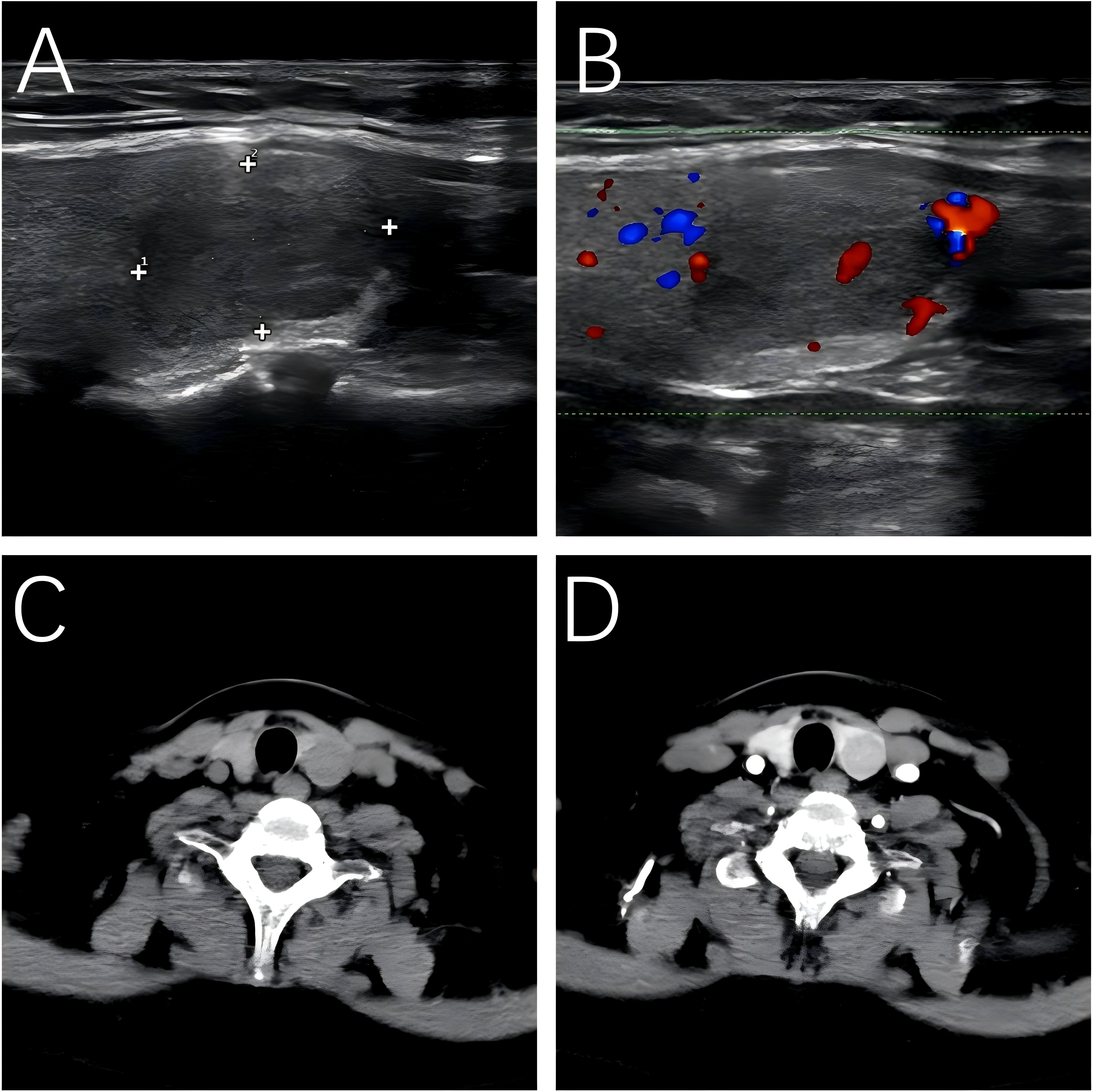 Ultrasound and CT scan images of the neck. Image A shows a cross-section with measurement markers. Image B displays blood flow with color Doppler. Images C and D are CT scans of the cervical spine from different angles, showing vertebrae and soft tissue details.