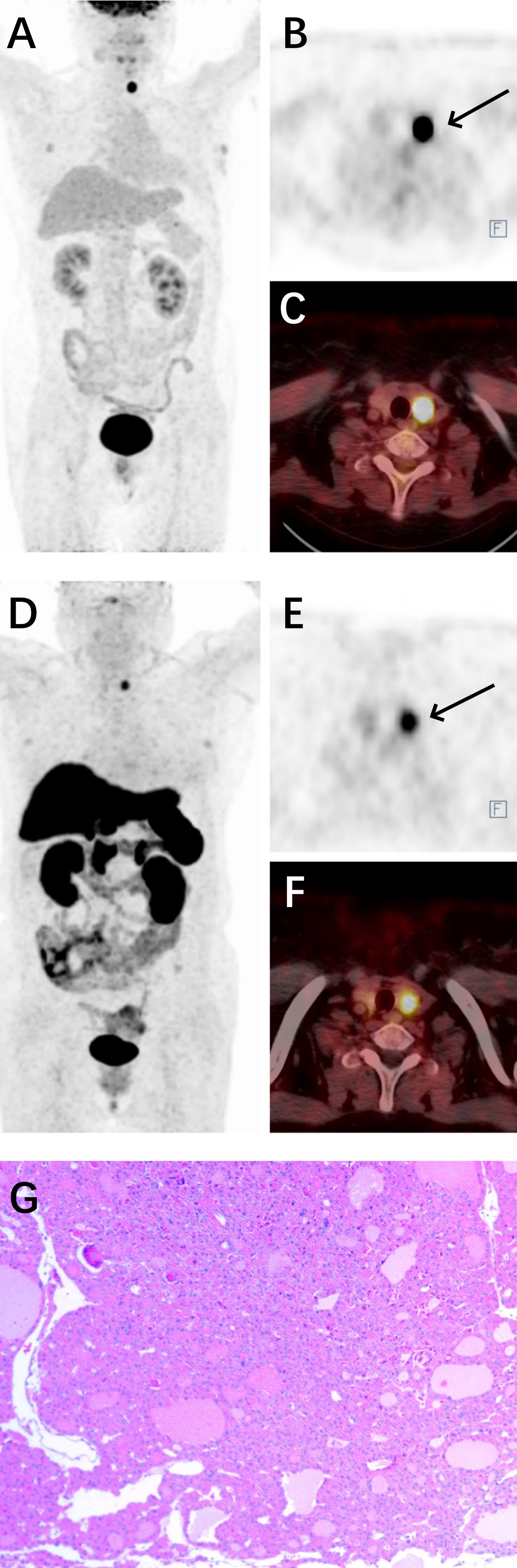 A series of five panels detail medical imaging and histology. Panel E shows a full-body PET scan highlighting metabolic activity. F is a zoomed view with an arrow pointing to a dark spot. G presents a color PET/CT fusion scan of the torso. H displays another PET scan of the upper body. I zooms in again, focusing on a dark area with an arrow. J shows a color PET/CT fusion image of the upper torso. K is a histological image stained in pink and purple, showing cellular structure.