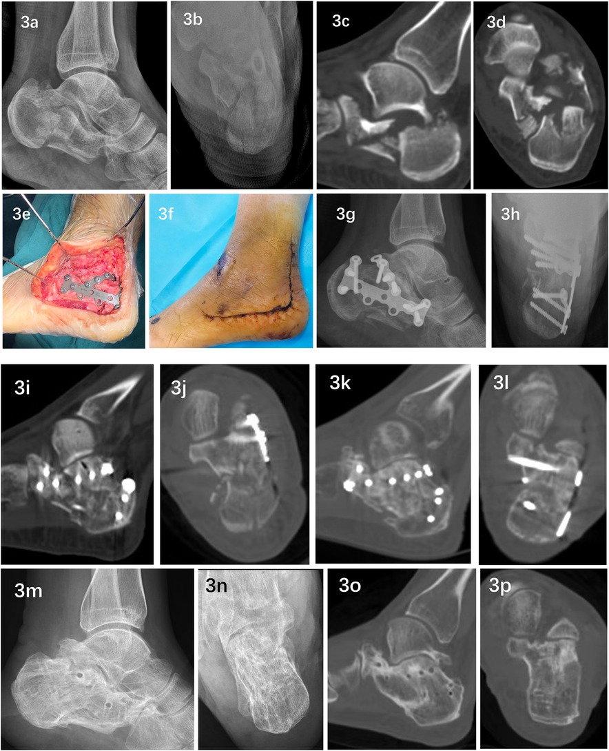 A series of medical images showing various angles of foot and ankle X-rays and scans. The images are labeled from 3a to 3p. Notable features include visible bone structures, surgical interventions with plates and screws, post-operative incision sites, and different imaging techniques such as X-ray and CT scans. Each panel captures different stages and aspects of medical evaluation and treatment.