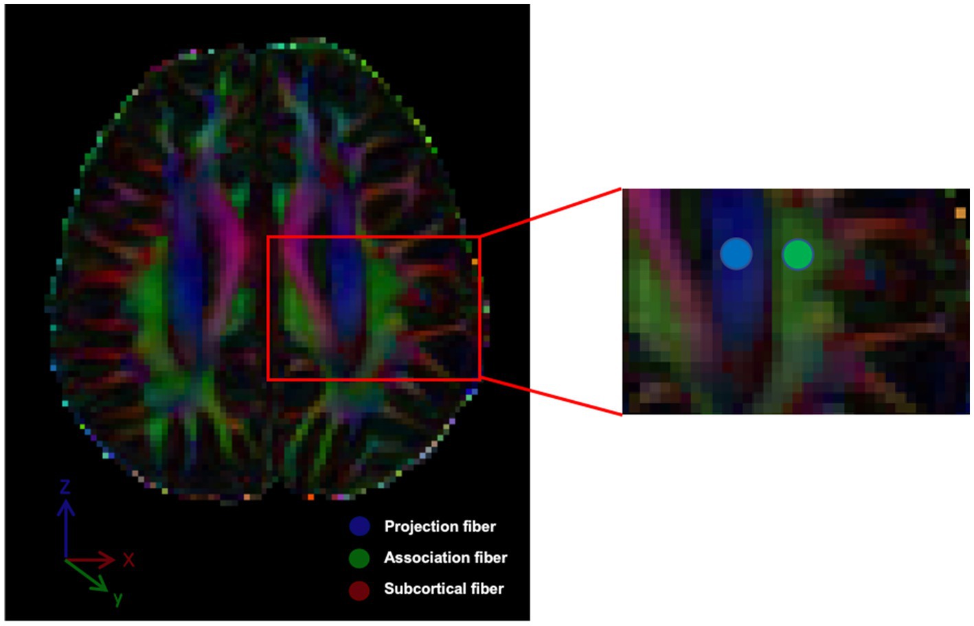 MRI scan of a human brain showing colored fibers: blue indicates projection fibers, green shows association fibers, and red displays subcortical fibers. A section is magnified on the right, highlighting fiber details. Axes for orientation are included with X (red), Y (green), and Z (blue).
