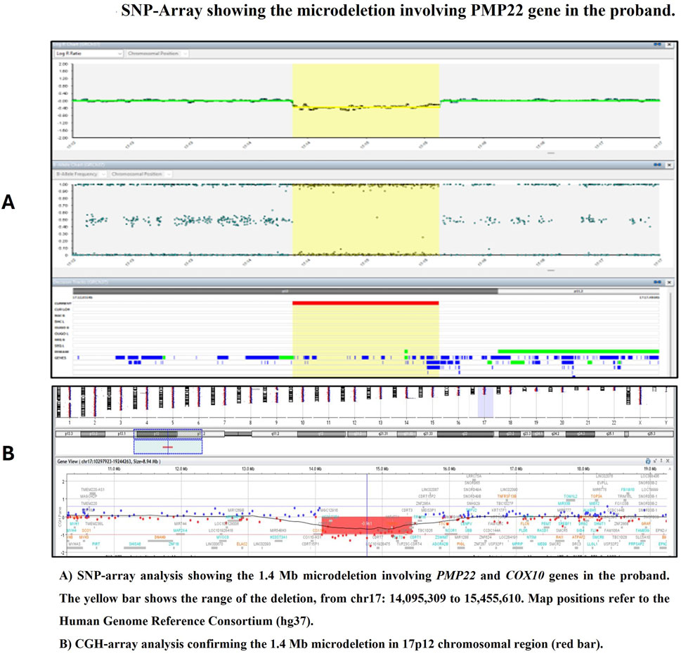 SNP-array and CGH-array analyses display a 1.4 Mb microdeletion in a proband, involving PMP22 and COX10 genes. The yellow and red bars highlight the deletion range on chromosome 17, positions 14,095,309 to 15,455,610, according to Human Genome Reference Consortium (hg37).