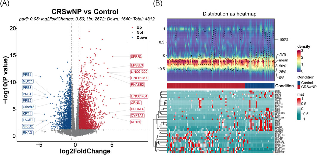 A two-part image comparing CRS with nasal polyps (CRSwNP) and controls. Panel A shows a volcano plot with genes significantly upregulated in CRSwNP in red and downregulated genes in blue. Notable genes include PRB4 and SPRR3. Panel B presents a heatmap depicting gene expression distributions, with varying densities and differences between control and CRSwNP conditions. Key genes are listed alongside a color-coded legend indicating expression levels.