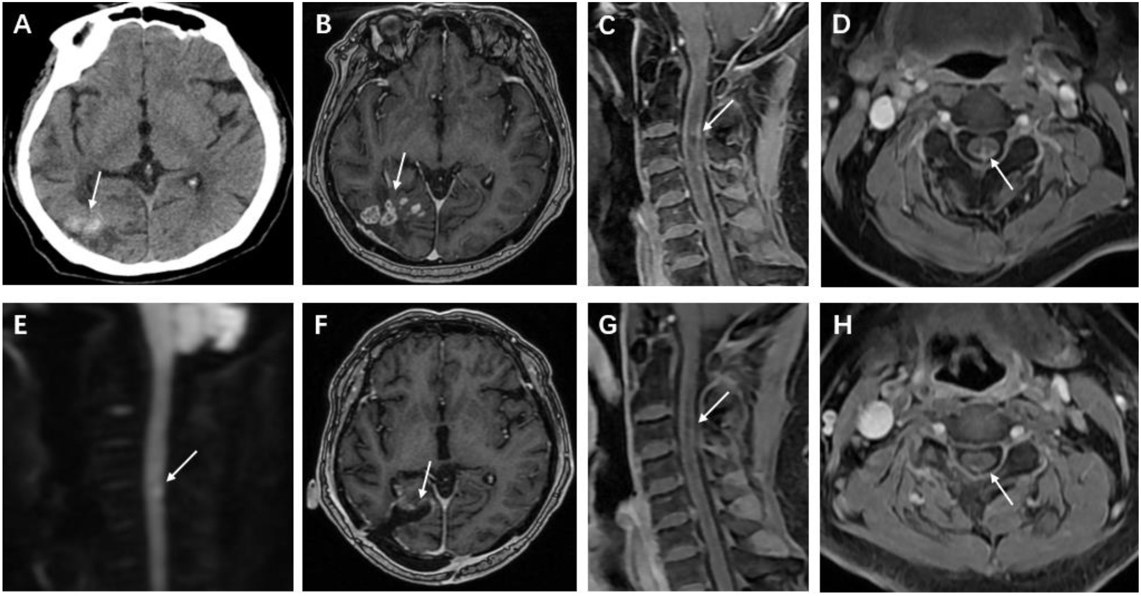 MRI and CT images in eight panels labeled A to H, showing different views of the brain and neck. White arrows point to areas of interest in each image, indicating abnormalities or focal lesions. Panels A, B, and F show horizontal brain scans with distinct bright spots. Panels C, E, and G depict sagittal views of the spine. Panels D and H show transverse sections of the neck. The images collectively highlight various abnormalities in the brain and cervical spine regions.