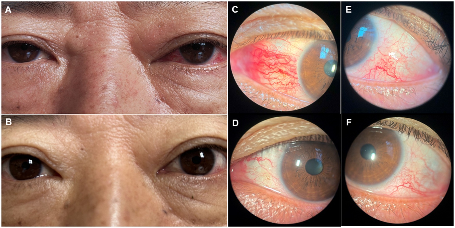 Figures A and B show clinical photographs of the patient's eyes before and after surgical treatment for left carotid cavernous sinus fistula. Figures C and D show the dilation and regression of the left eye nasal conjunctival blood vessels before and after surgery. Figures E and F show the dilation and regression of left temporal conjunctival blood vessels before and after surgery.