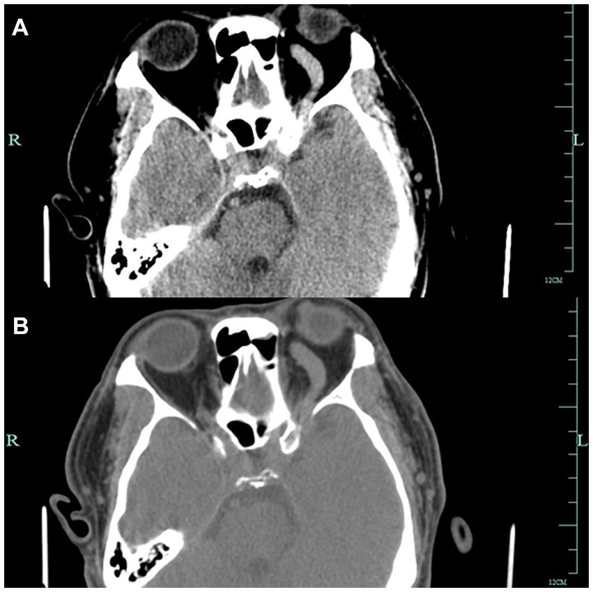 Figures G and H show Axial CT images showing left-sided proptosis with scleral thickening. The left optic foramen is enlarged, and the left cavernous sinus exhibits heterogeneous density. The left superior orbital vessels appear tortuous and dilated.