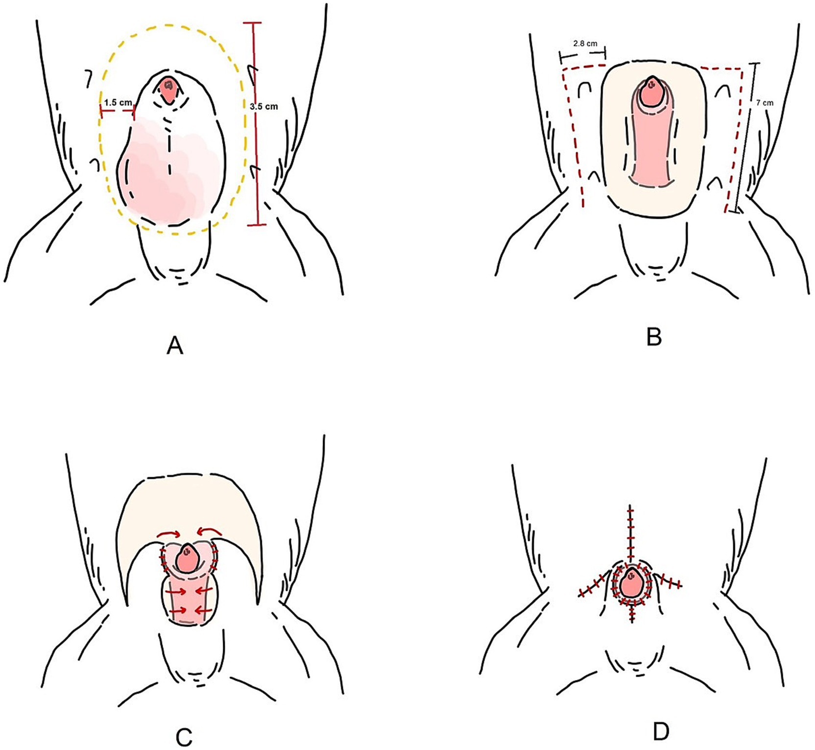 Four illustrations labeled A to D depict surgical procedures for a specific operation. A shows an incision with vertical and horizontal measurements. B displays a rectangular area with dimensions outlined. C illustrates a circular incision with arrows indicating direction. D features a stitched area with crosses marking stitches and arrows showing closure direction.