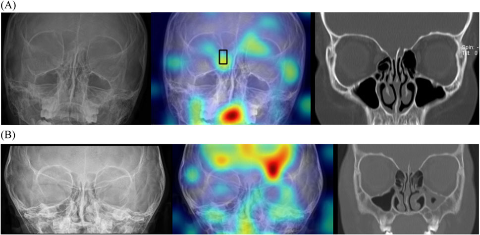 Panel A and B each contain three images of a skull in coronal view. The images on the left are X-rays, the middle images show heatmaps with highlighted areas in red, yellow, and blue, indicating different levels of intensity, and the images on the right are CT scans displaying detailed bone structures.