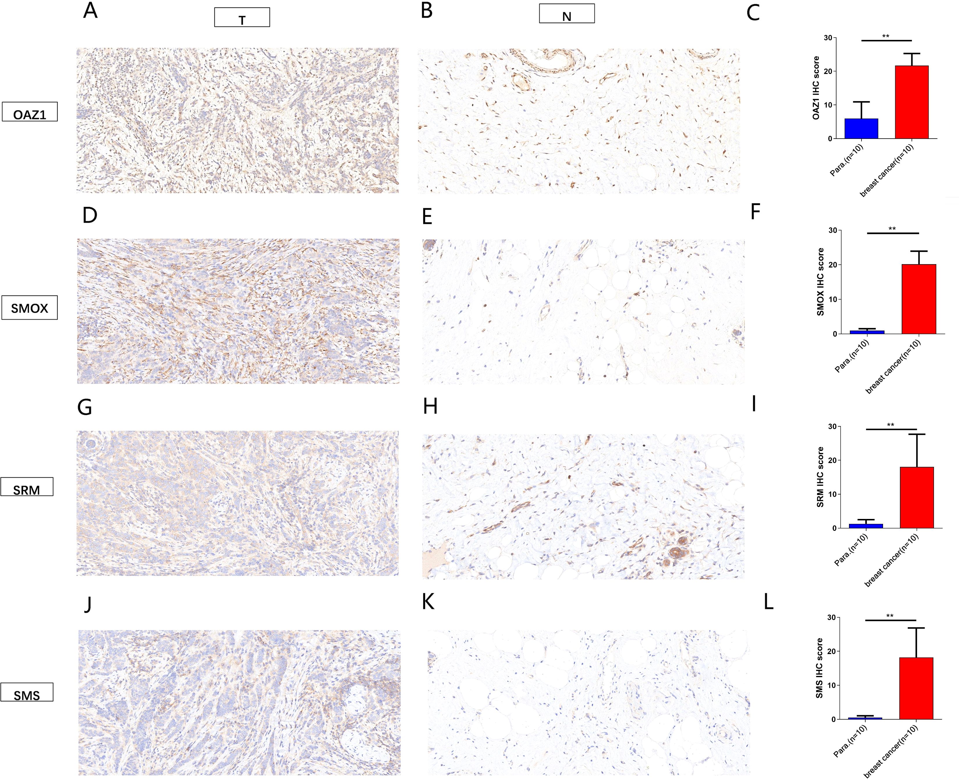 Immunohistochemistry analysis comparing tumor (T) and normal (N) tissue samples for OAZ1, SMOX, SRM, and SMS proteins. Panels A, D, G, J show tumor tissues; B, E, H, K show normal tissues. Bar graphs C, F, I, L depict significantly higher IHC scores for breast cancer samples compared to para-carcinoma tissues across all proteins.