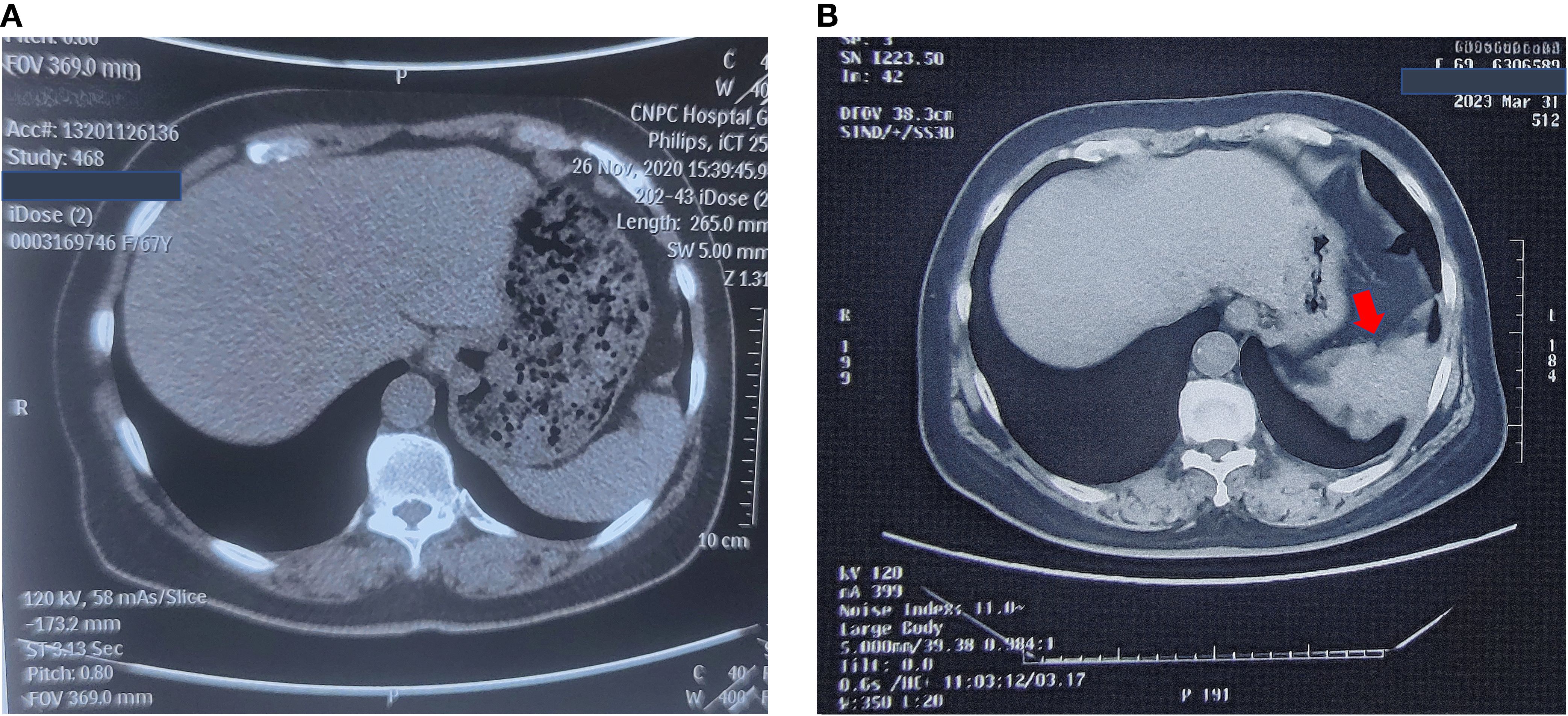 CT scans of the abdomen showing two different views from two time points. The left cross-sectional scan, obtained at initial presentation, shows no definite abnormality, whereas the right image—acquired afterward—uses a red arrow to indicate a newly developed space-occupying lesion that marks the first radiographic evidence of disease development.