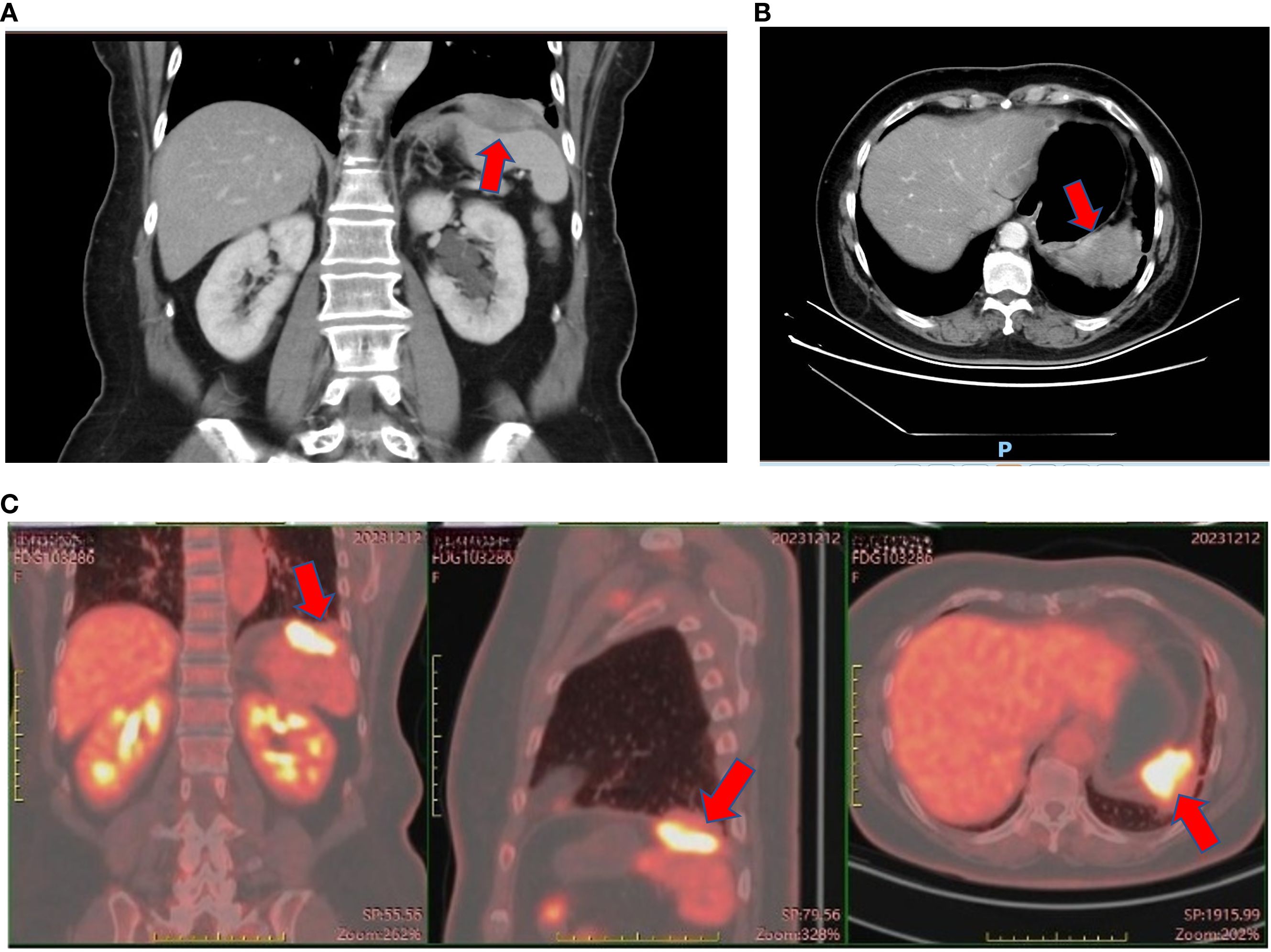 CT and PET scans showing different perspectives of abdominal structures. Panel a: Coronal CT scan with a red arrow indicating the mass near the spleen. Panel b: Axial CT scan with a red arrow pointing to a mass near the spleen. Panel c: Three images from a PET scan showing hypermetabolic mass, marked with red arrows.