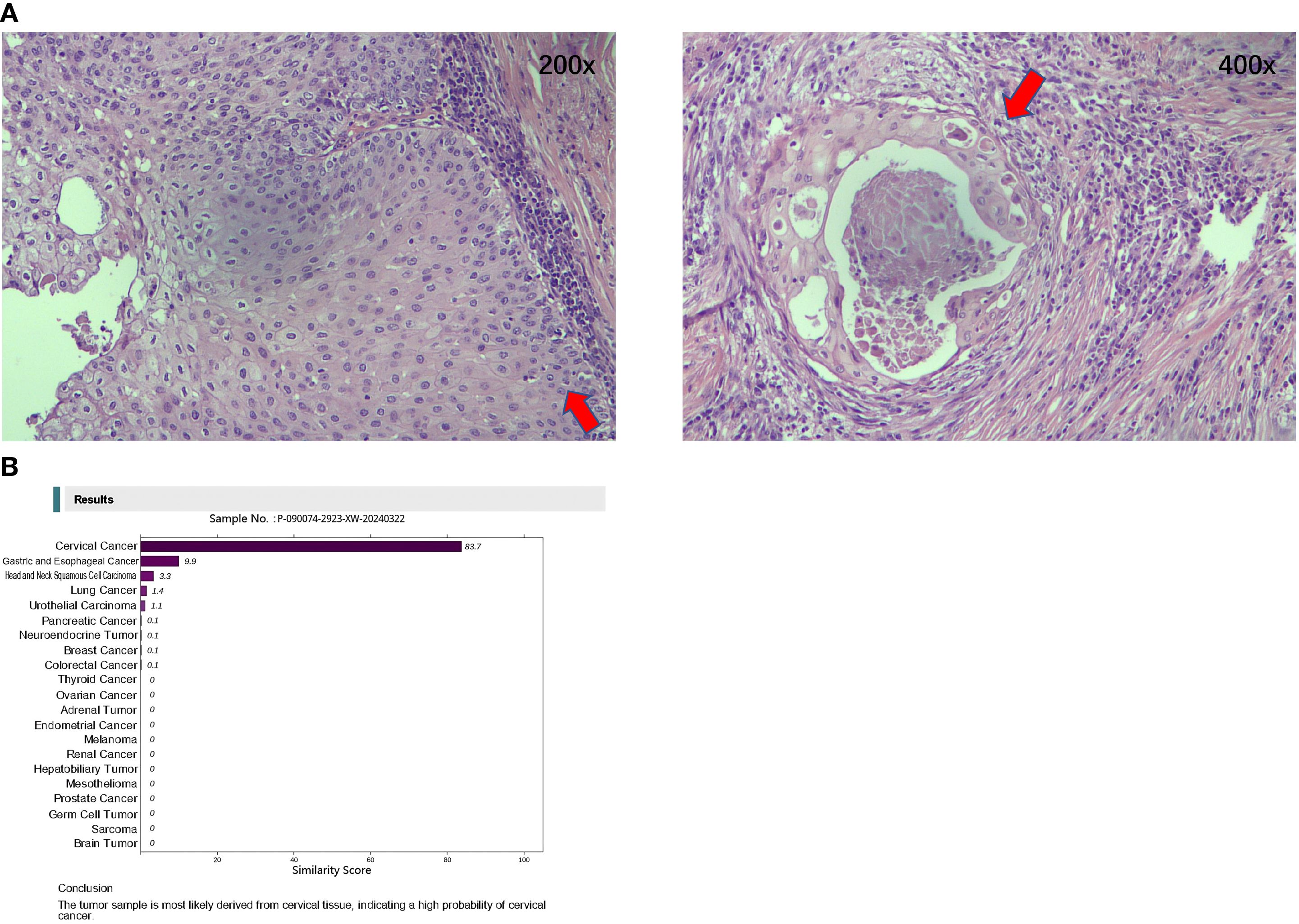 Two histology images and a bar chart are shown. The left image is at 200x magnification highlighting squamous cell cancer region with a red arrow. The right image at 400x magnification shows more detailed cellular features, also marked by a red arrow. Below them, a bar chart presents similarity scores for various cancers, emphasizing a high probability of cervical cancer. The conclusion confirms the tumor sample likely stems from cervical tissue, indicating a strong likelihood of cervical cancer.