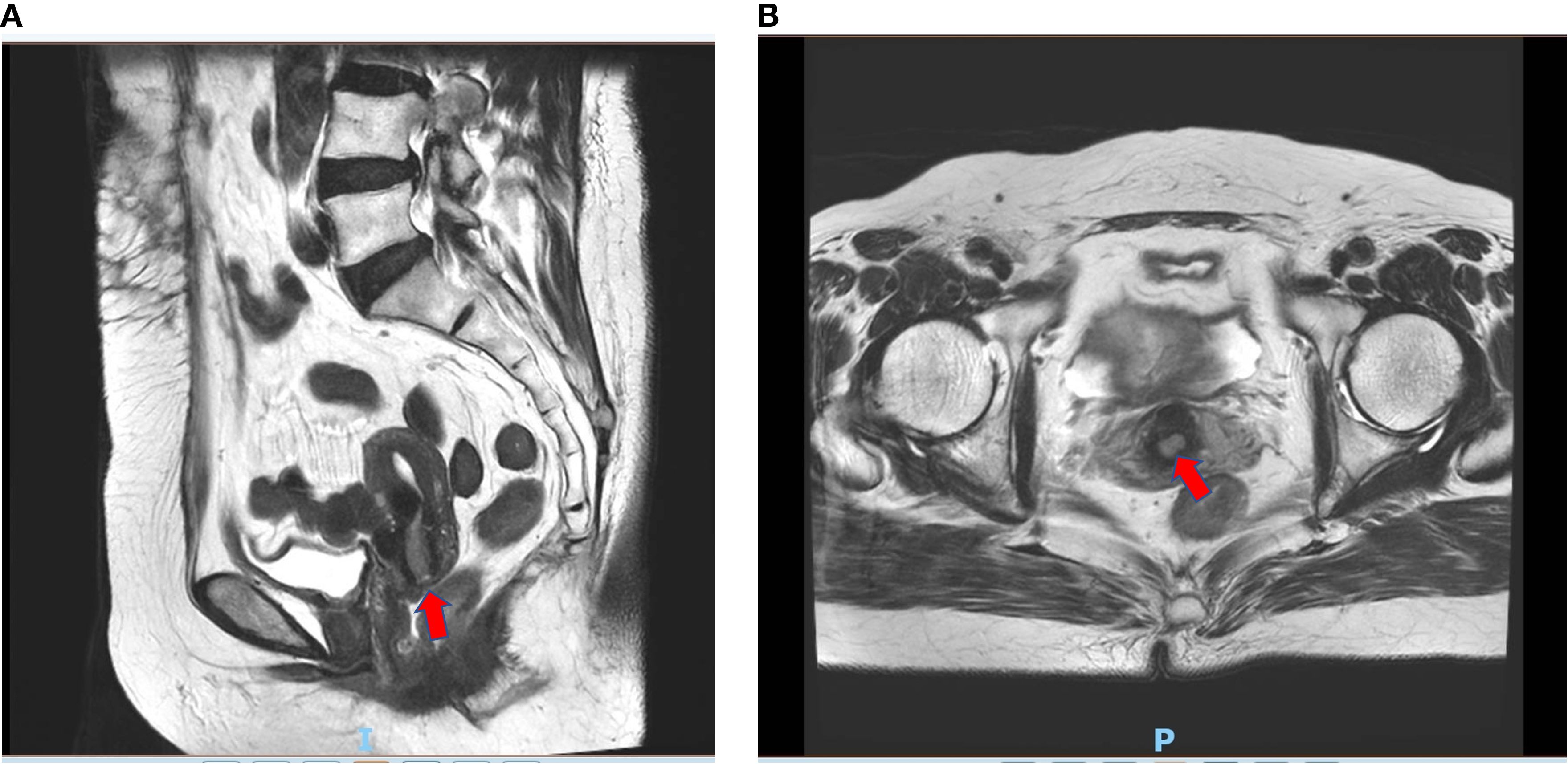 Text Two MRI scans showing pelvic anatomy. In both images, red arrows highlight suspected cervical lesion. The left image 'a' is a sagittal view; and the right image 'b' is a transverse view of the pelvis.