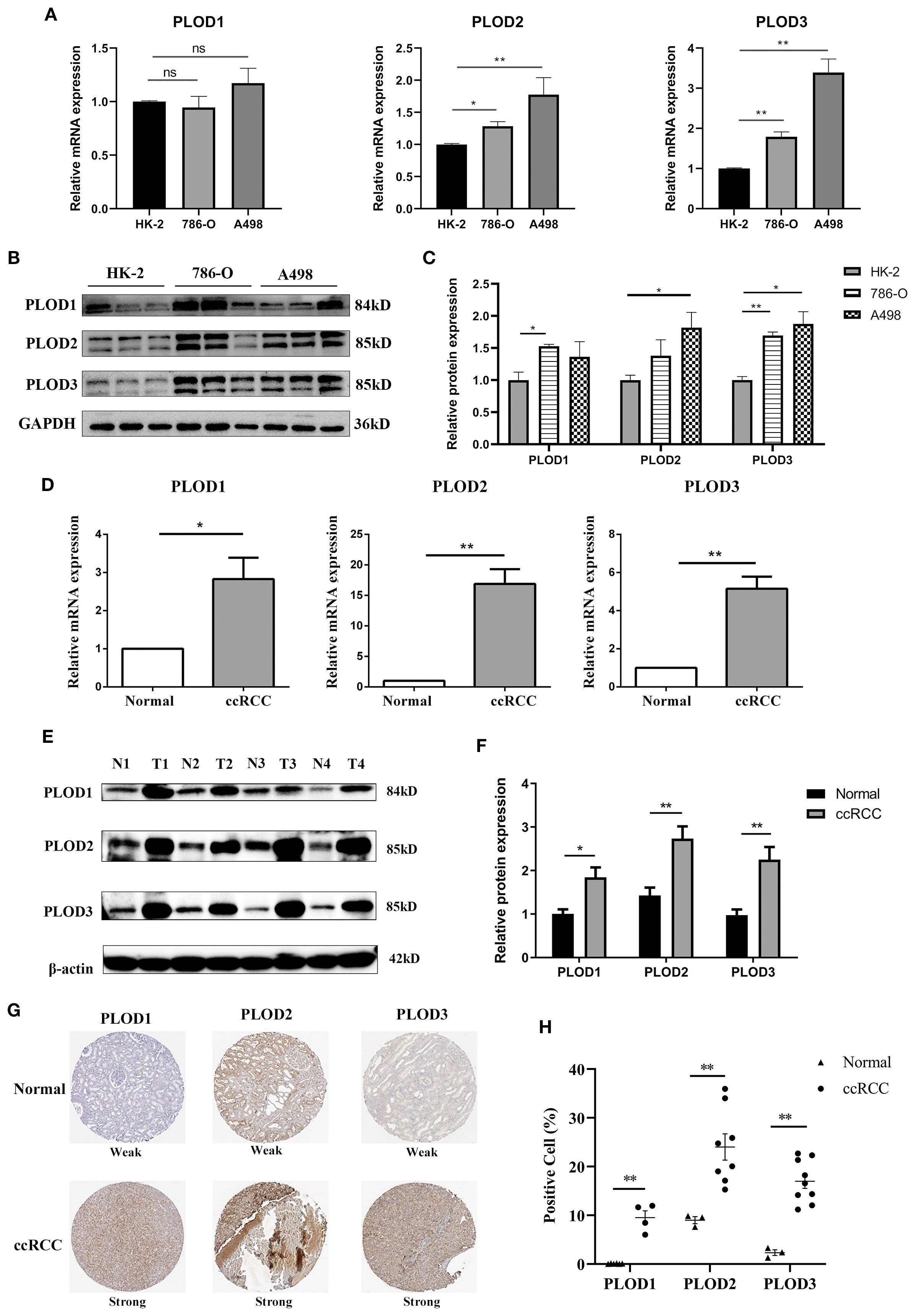 Graphs and images depict the expression levels of PLOD1, PLOD2, and PLOD3 in different cell types and conditions. Panels show relative mRNA and protein expressions in HK-2, 786-O, and A498 cells, with comparisons between normal and ccRCC samples. Western blots indicate protein levels, while diagrams illustrate expressions in normal and ccRCC tissues with varying strengths. Statistical significance is denoted by asterisks.