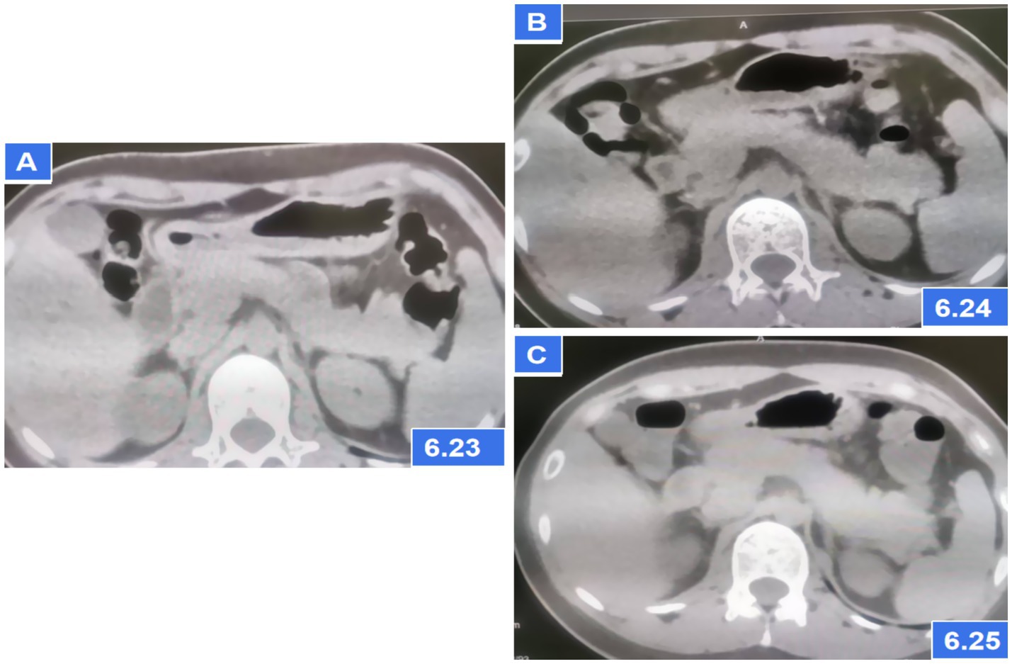 CT scan images displaying three transverse abdominal views labeled A, B, and C. Each shows sections with varying levels of contrast and shapes indicating different anatomical features. Labeled numbers 6.23, 6.24, and 6.25 correspond to each panel, respectively.