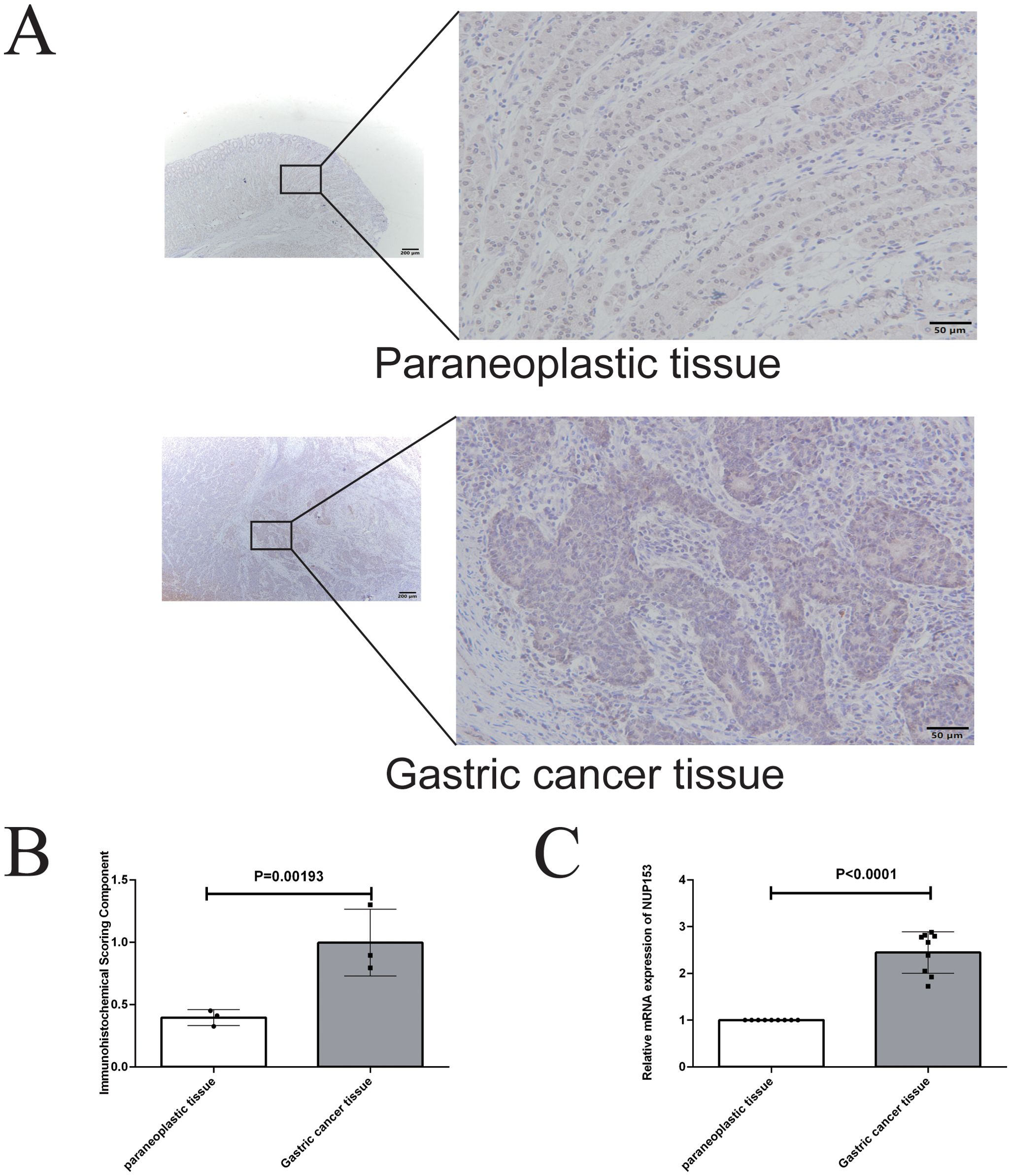 Panel A shows histological images of paraneoplastic and gastric cancer tissues with higher magnification insets. Panel B is a bar graph showing the immunohistochemical scoring component, indicating higher scores in gastric cancer tissue compared to paraneoplastic tissue, with a P-value of 0.00193. Panel C is a bar graph illustrating relative mRNA expression of UMPS, showing elevated expression in gastric cancer tissue versus paraneoplastic tissue, with a P-value less than 0.0001.