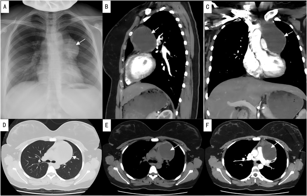 Chest imaging series showing six panels labeled A to F:\n\nA: x-ray displaying a circular shadow in the right upper lung. \nB: Sagittal CT showing a round mass near the trachea. \nC: Coronal CT illustrating a large circular mass in the mediastinum. \nD: Axial CT revealing a mass pressing on the right lung. \nE: Axial CT with contrast showing the mass with clearer borders. \nF: Post-contrast axial CT highlighting the mass adjacent to major vessels.