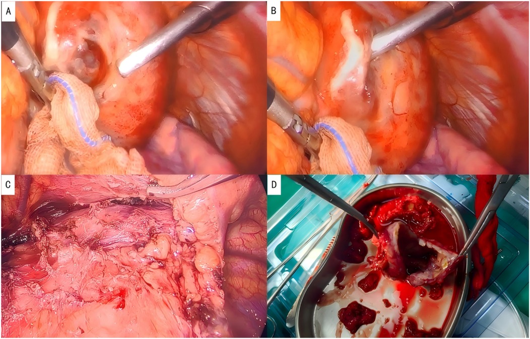 Four images depicting a surgical procedure. A and B show close-up views of a surgical area with tools and tissue interaction. C displays an exposed surgical site with tissues visible. D shows extracted tissue in a metal tray with blood.