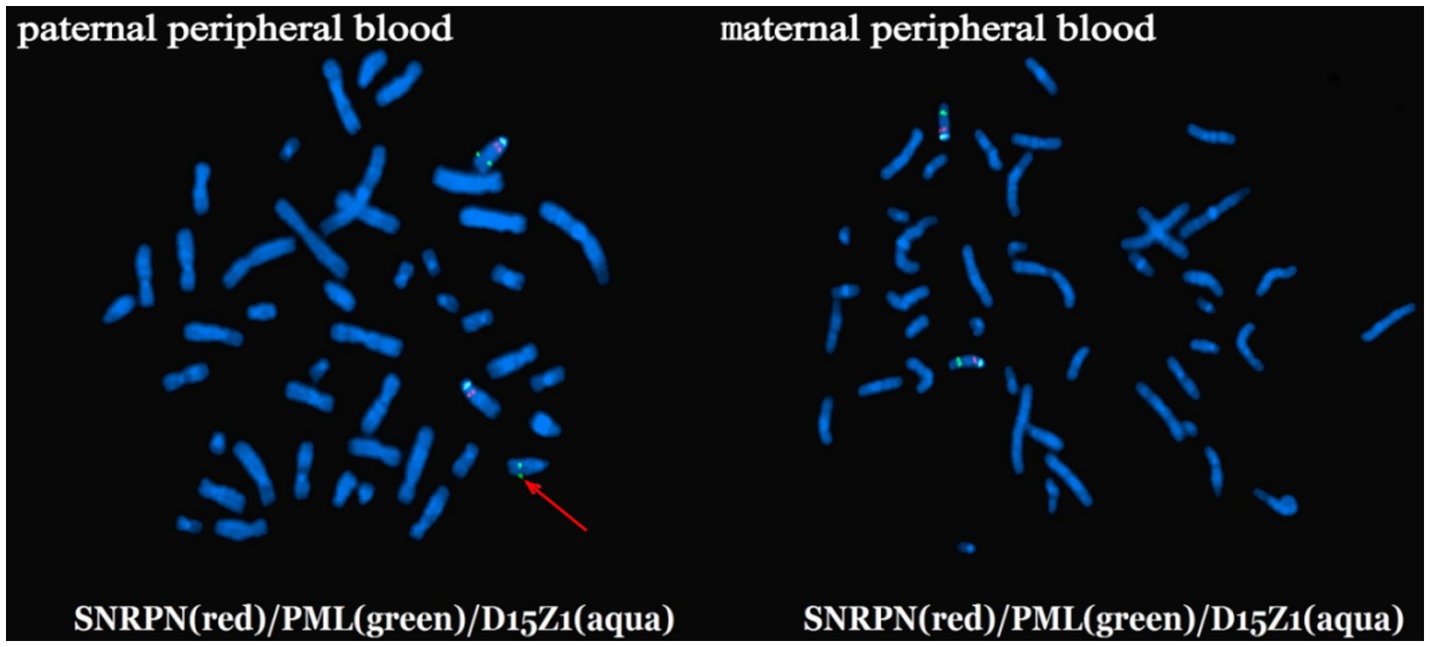 Fluorescence in situ hybridization (FISH) images showing chromosomes from paternal and maternal peripheral blood. The chromosomes are stained blue, with specific regions highlighted: SNRPN in red, PML in green, and D15Z1 in aqua. A red arrow points to a specific chromosome region in the paternal sample.