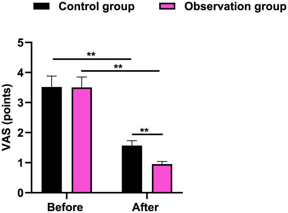 Bar chart showing average VAS points (vertical axis) for control (black) and observation (purple) groups before and after treatment. Both groups start around 3 points. After treatment, the control group is slightly above 2 points, while the observation group drops below 1. Statistically significant differences are noted with asterisks.
