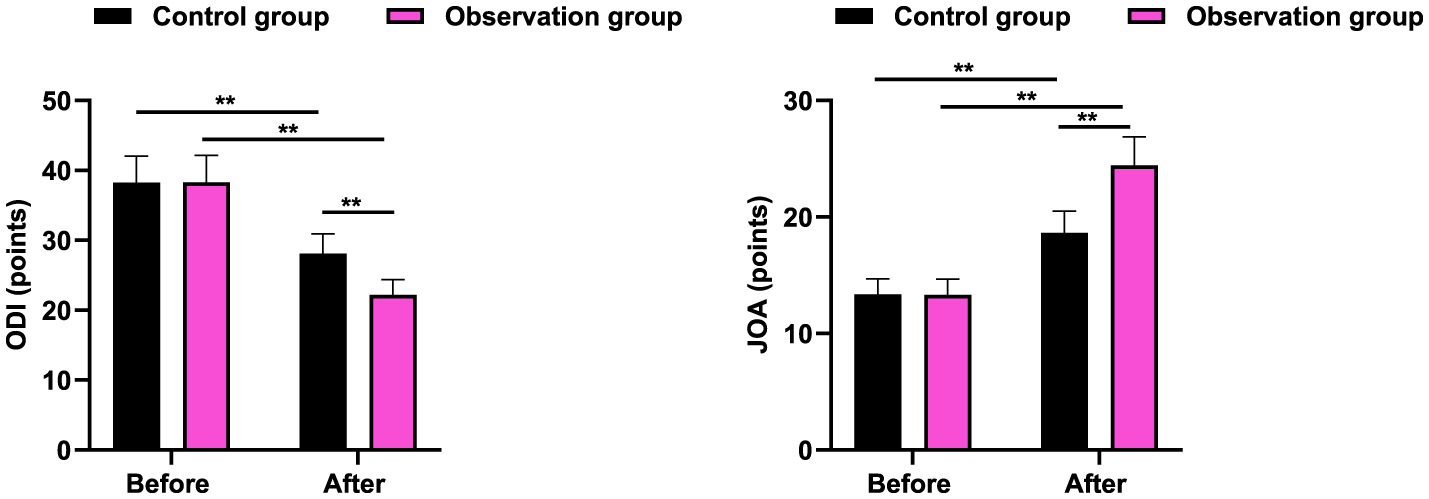 Bar charts comparing ODI and JOA scores for control and observation groups before and after an intervention. The observation group shows a significant improvement in both measures. Statistical significance is indicated by asterisks.