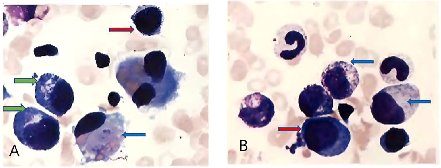 A and B show different microscopic fields from bone marrow cytology demonstrating hemophagocytosis. Red arrows indicate hemophagocytes, characterized by deep blue, round, or irregularly shaped cells. Blue arrows point to larger deep blue cells with pale intracellular areas, representing hemophagocytes actively engulfing erythrocytes. Green arrows highlight smaller, round, deep blue cells with irregular margins, which correspond to hemophagocytes phagocytosing platelets. Original magnification ×400.