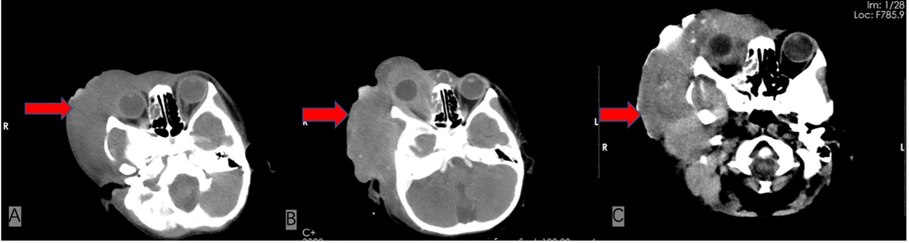Cranial imaging findings of the patient at admission and before/after treatment. (A) Admission CT: right facial mass with zygomatic arch osteolysis. (B) Post-4-cycle chemotherapy CT: enlarged right facial mass, new metastatic lesions, and narrowed external auditory canal. (C) Pre-mortem CT: partial tumor regression with increased calcification.