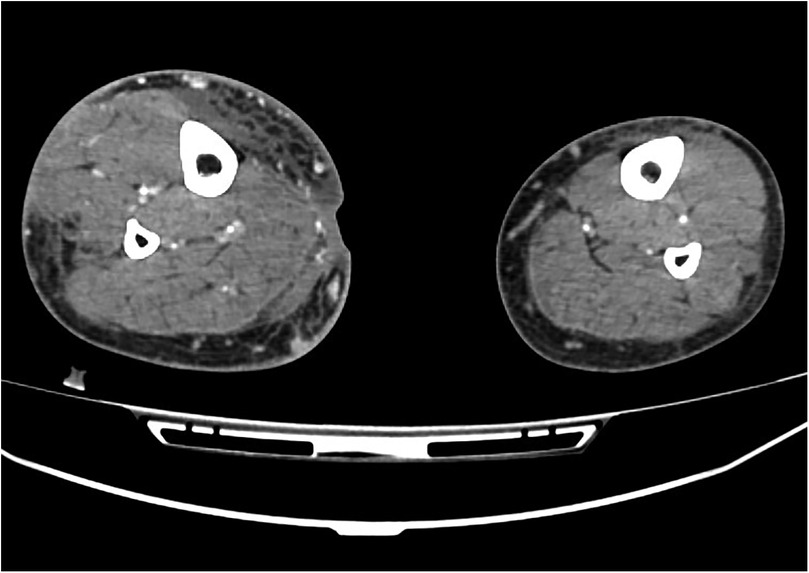 CT scan image showing a cross-sectional view of two muscle compartments, likely the thighs. Muscle tissue appears in varied shades of gray with distinct central white areas indicating bones and vascular structures.