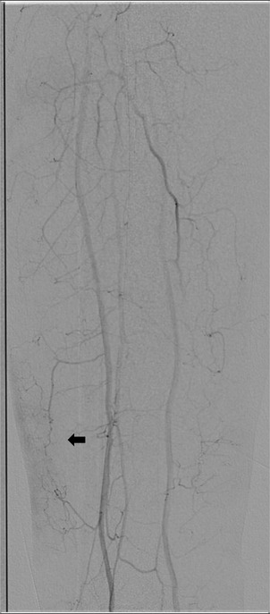 Angiogram showing the vascular structure, including arteries and veins, with contrasted pathways visible against a gray background. Fine branches and thicker vessels are detailed, illustrating blood flow.
