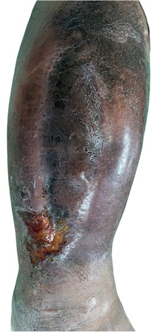 A discolored human leg with a large, darkened area and a prominent, inflamed wound or ulceration near the ankle, showing signs of infection or poor circulation.