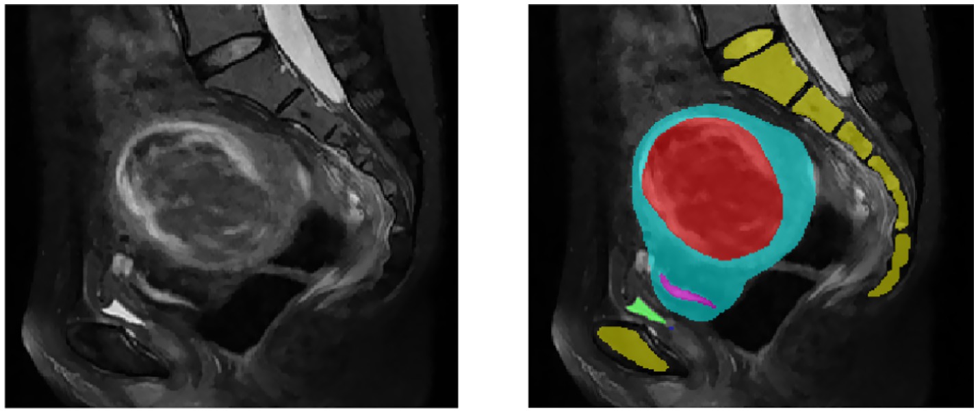 MRI images of the pelvis in sagittal view. The left image shows a grayscale scan. The right image features color-coded segments: red, blue, yellow, pink, and green indicate different anatomical regions.