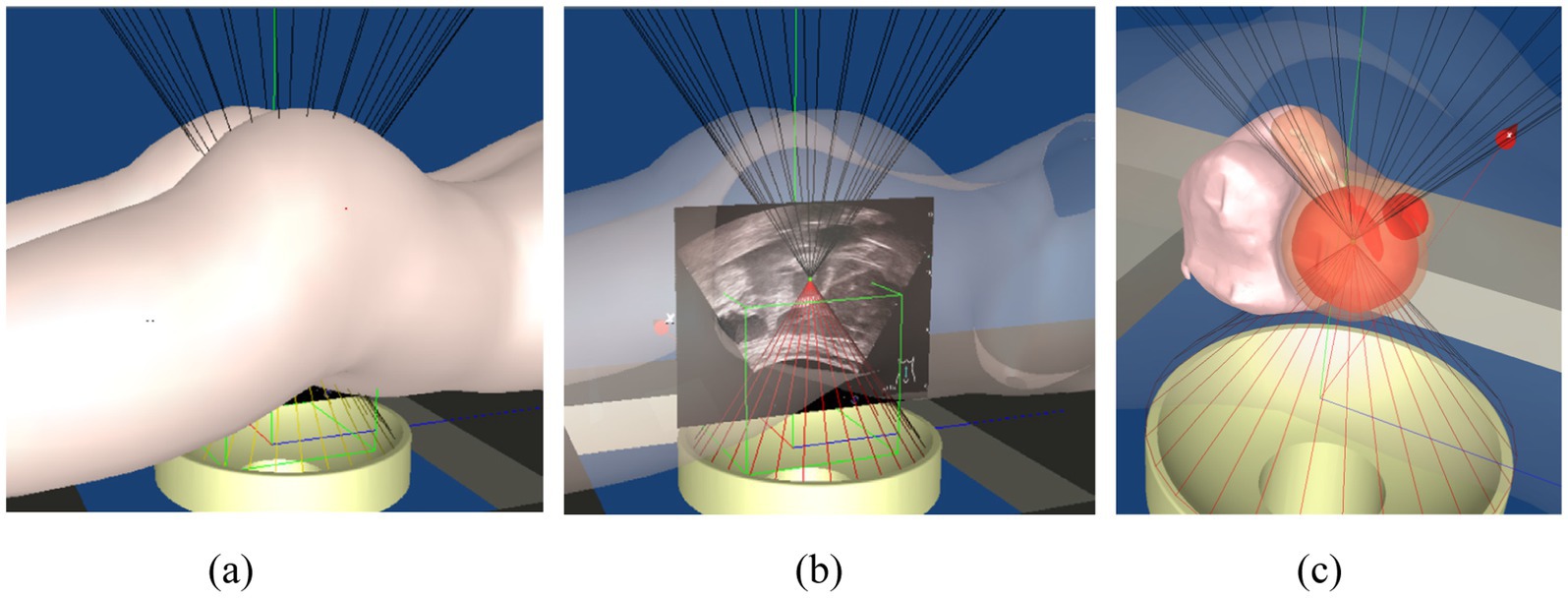 Three panels illustrate a procedure involving targeted imaging or treatment. (a) A model with lines converging on a pelvic area. (b) Same setup with an ultrasound image overlay, showing internal structures. (c) Lines converge on a highlighted red area, indicating a specific focus, possibly a tumor or treatment site.