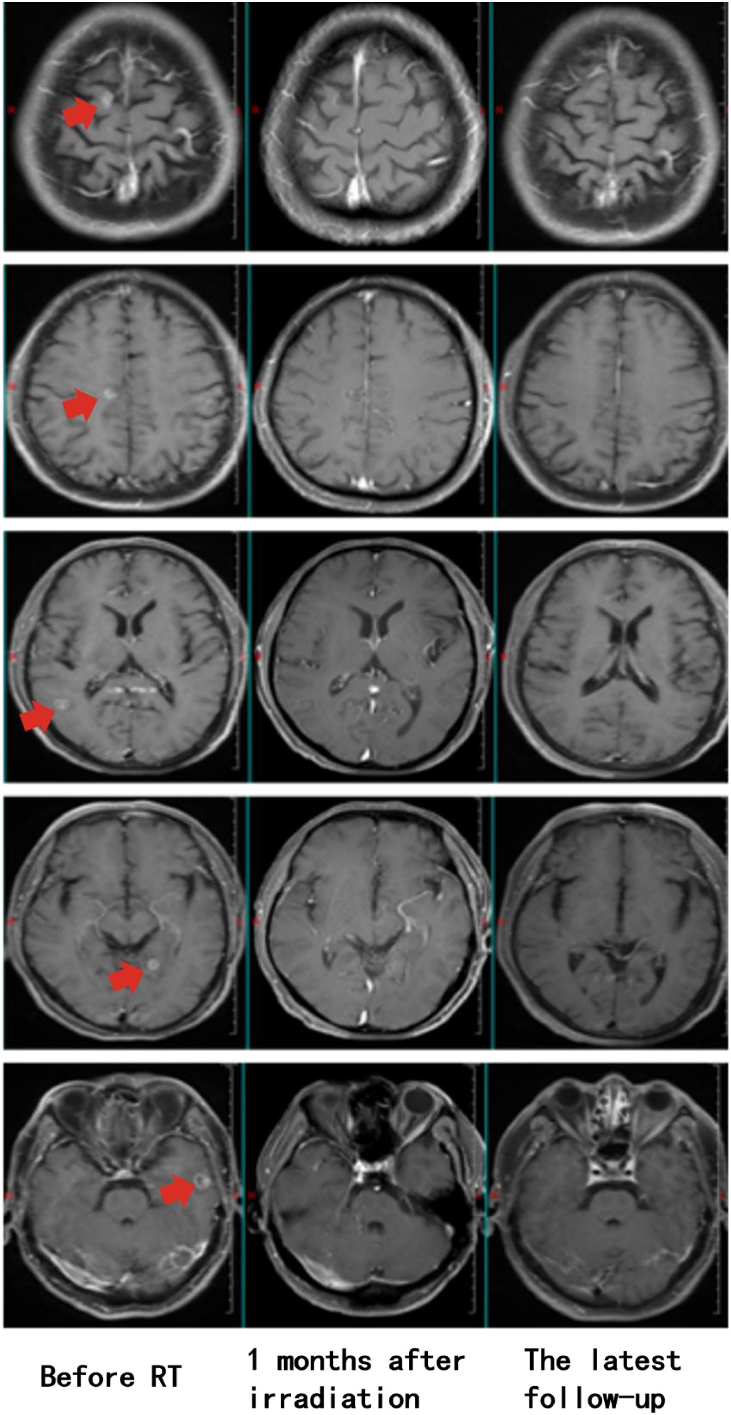 Series of brain MRI scans showing changes over time. Each row represents three time points: before radiotherapy (RT), one month after irradiation, and the latest follow-up. Red arrows indicate areas of interest in the brain. The scans display variations in brain structure and potential treatment effects. The images highlight the progression or reduction of abnormalities across different timeframes.