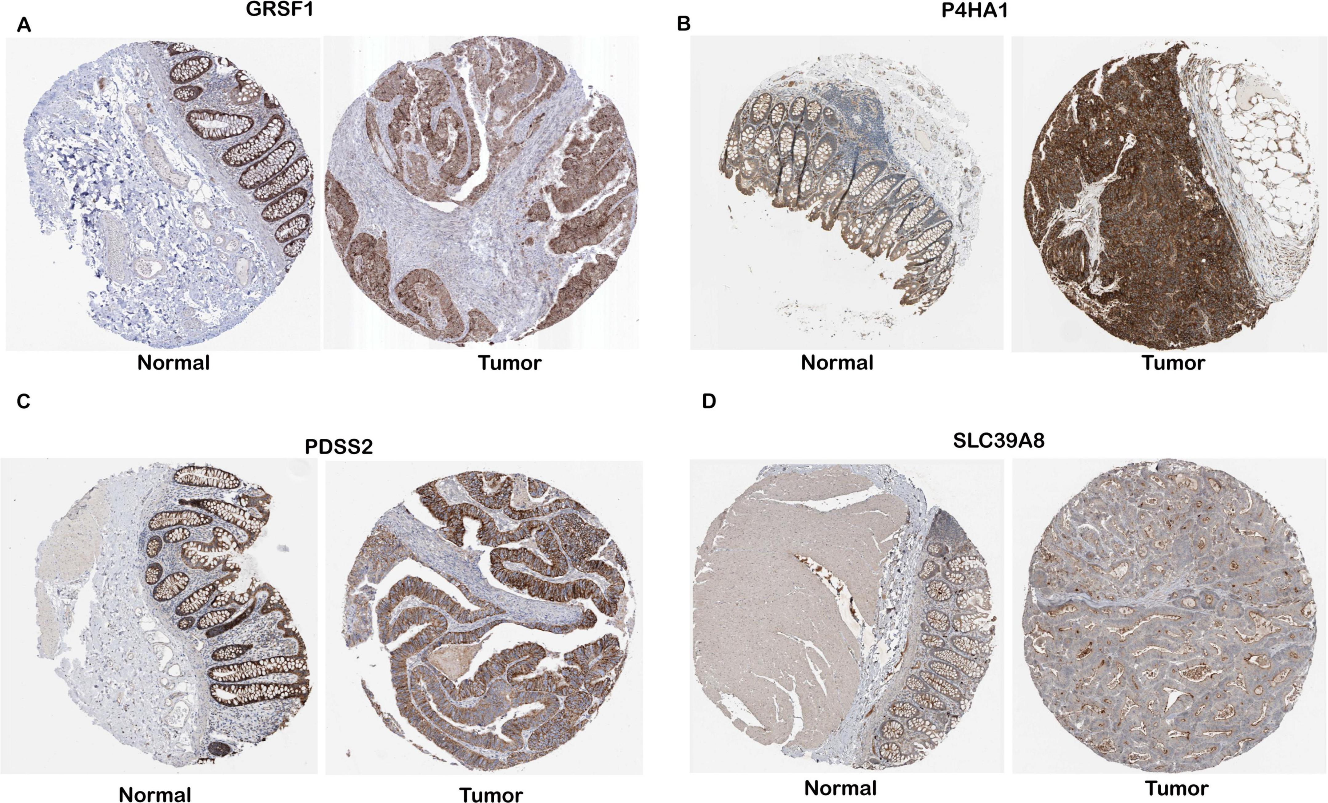 Immunohistochemistry images showing normal and tumor tissues for four proteins: GRSF1, P4HA1, PDSS2, and SLC39A8. Each section displays a pair of circular tissue samples, with the left representing normal tissue and the right showing tumor tissue. The staining intensity differs between normal and tumor samples for each protein.