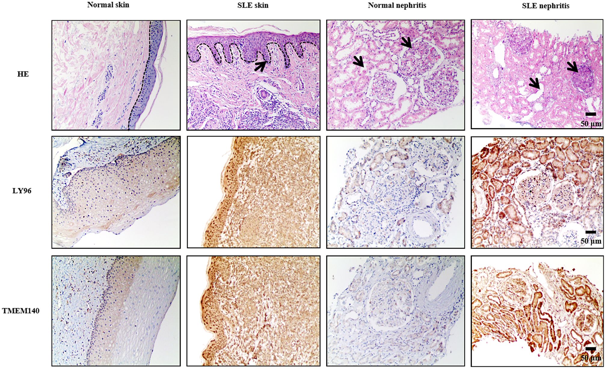 Microscopic images comparing normal and SLE-affected skin and nephritis tissues. HE staining shows structural differences with arrows highlighting specific areas. LY96 and TMEM140 stainings indicate protein expression variations across conditions, with dark staining suggesting higher levels. Scale bars show 50 micrometers.