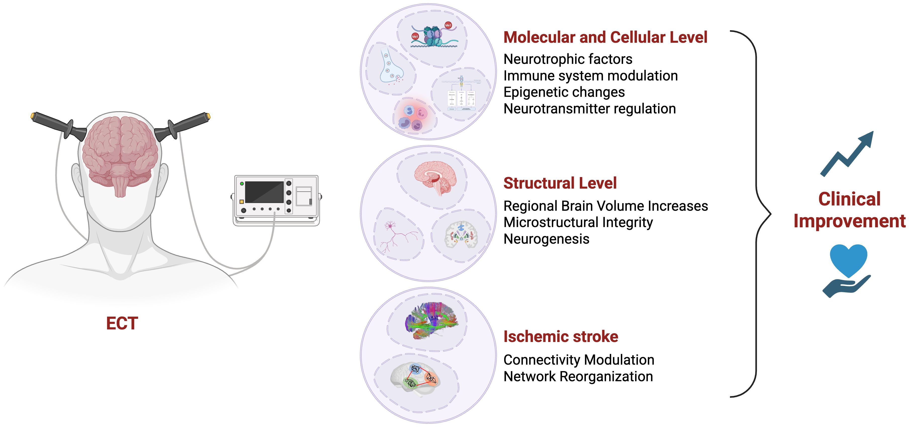 Illustration of ECT effects on the brain at molecular, cellular, structural, and ischemic stroke levels, leading to clinical improvement. Shows ECT machine connected to a brain, with diagrams highlighting neurotrophic factors, brain volume increase, connectivity modulation, and related enhancements.