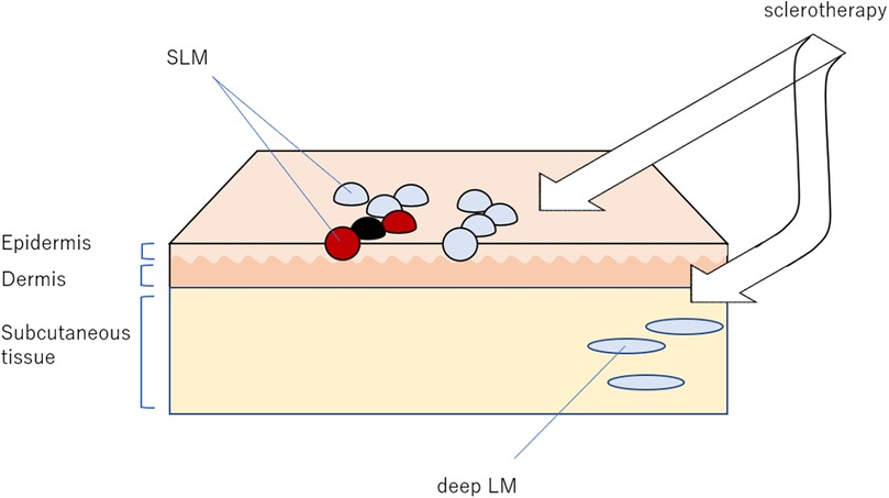 Illustration of skin layers and sclerotherapy. The image shows the epidermis, dermis, and subcutaneous tissue. Arrows indicate sclerotherapy treatment targeting surface lesions (SLM) and deeper lesions (deep LM) with red and black dots on the surface.
