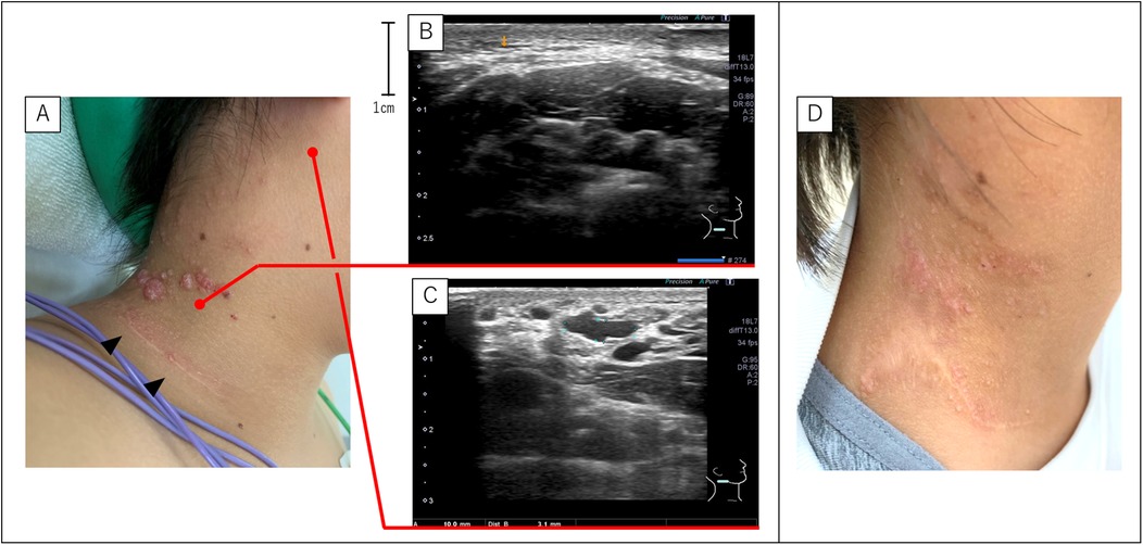 Four-panel image showing a clinical case of neck lesions. Panel A displays multiple pink nodular skin lesions on the neck. Panels B and C present ultrasound images of these lesions, showing internal characteristics. Panel D illustrates the same neck area post-treatment, with visible reduction in lesions.