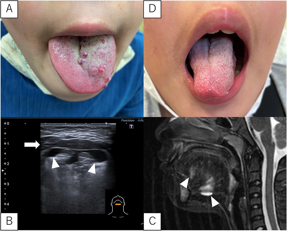 Four images labeled A to D. Image A shows a tongue with multiple lesions or swelling. Image B is an ultrasound scan with arrowheads indicating specific areas. Image C is an MRI scan with white markers highlighting certain features. Image D shows a tongue with a smoother texture and fewer abnormalities.