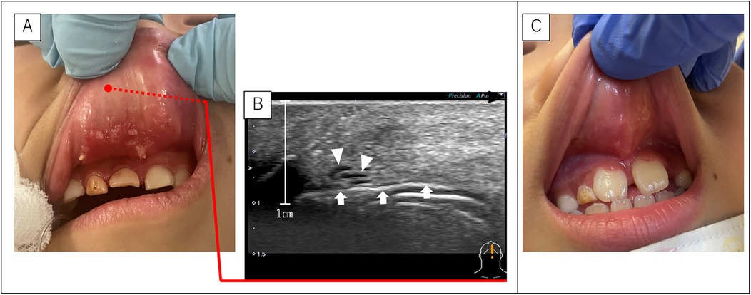 Panel A shows multiple SLM on the upper lip inside the oral cavity. Panel B is an ultrasound scan with arrowheads indicating specific areas. Panel C displays the same region after treatment, with disappearance of the SLM.