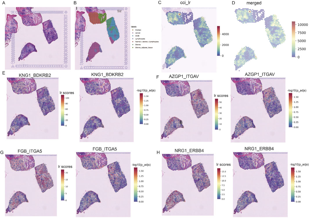 Histological images of tissue sections with various overlays and color scales. - A: Tissue sections with grid overlay.- B: Tissue with colored regions labeled as distinct types: anticancer, cancer, ducts, lymphocytes, normal stroma, and stromal adipose tissue.- C: Color scale showing cci_lr values.- D: Color scale showing merged values.- E-H: Panels showing ligand-receptor (lr) scores for pairs KNG1_BDKRB2, AZGP1_ITGAV, FGB_ITGA5, and NRG1_ERBB4 with p-value significance overlays. Each panel includes a color scale indicating score intensity or statistical significance.