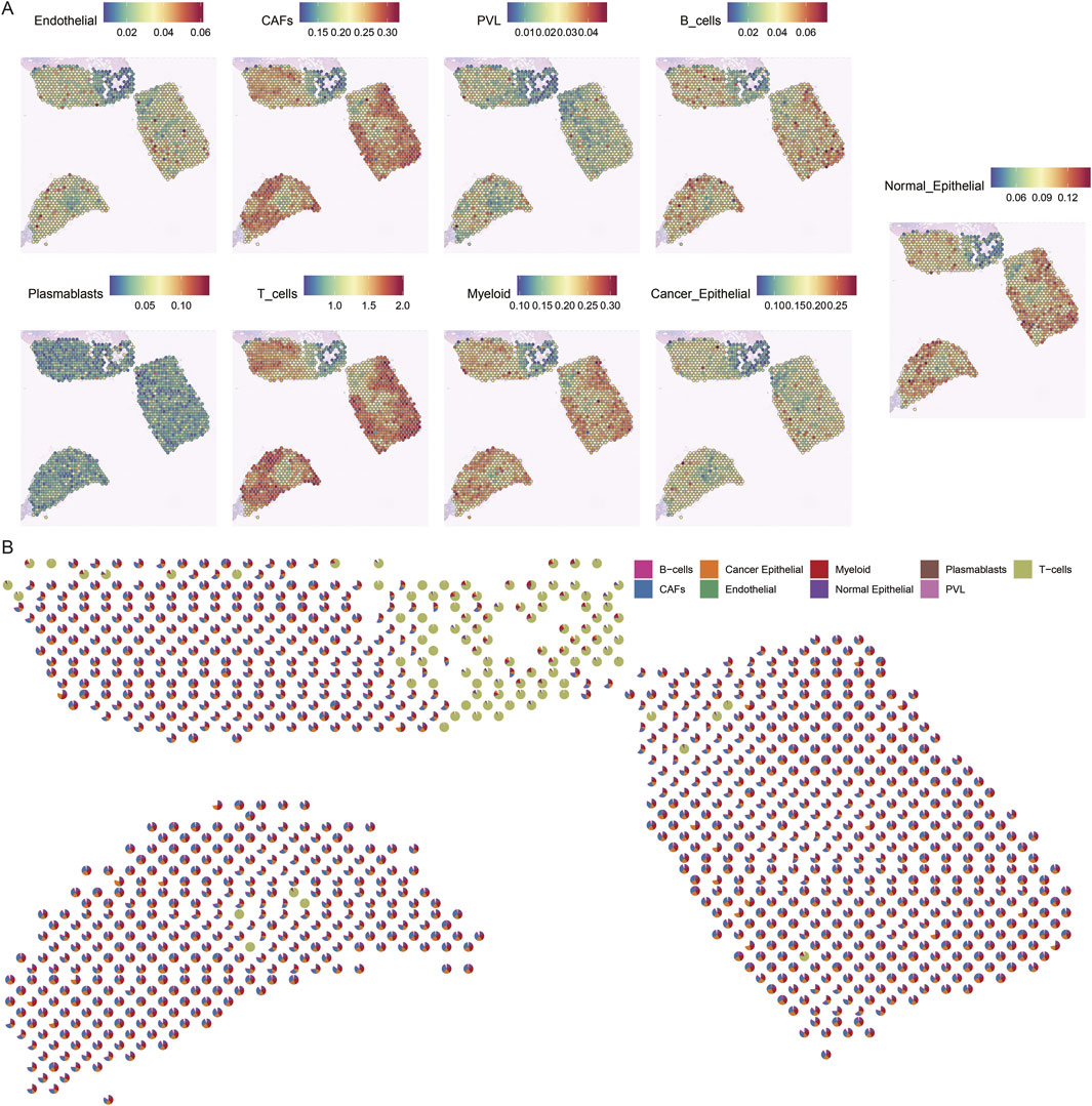 Panel A displays multiple heat maps showing the expression levels of various cell types, including endothelial, CAFs, PVL, B-cells, plasmablasts, T-cells, myeloid, cancer epithelial, and normal epithelial. Color gradients indicate expression intensity. Panel B illustrates a spatial distribution map of these cell types in a tissue sample, with each cell type represented by different colors as indicated by the legend.