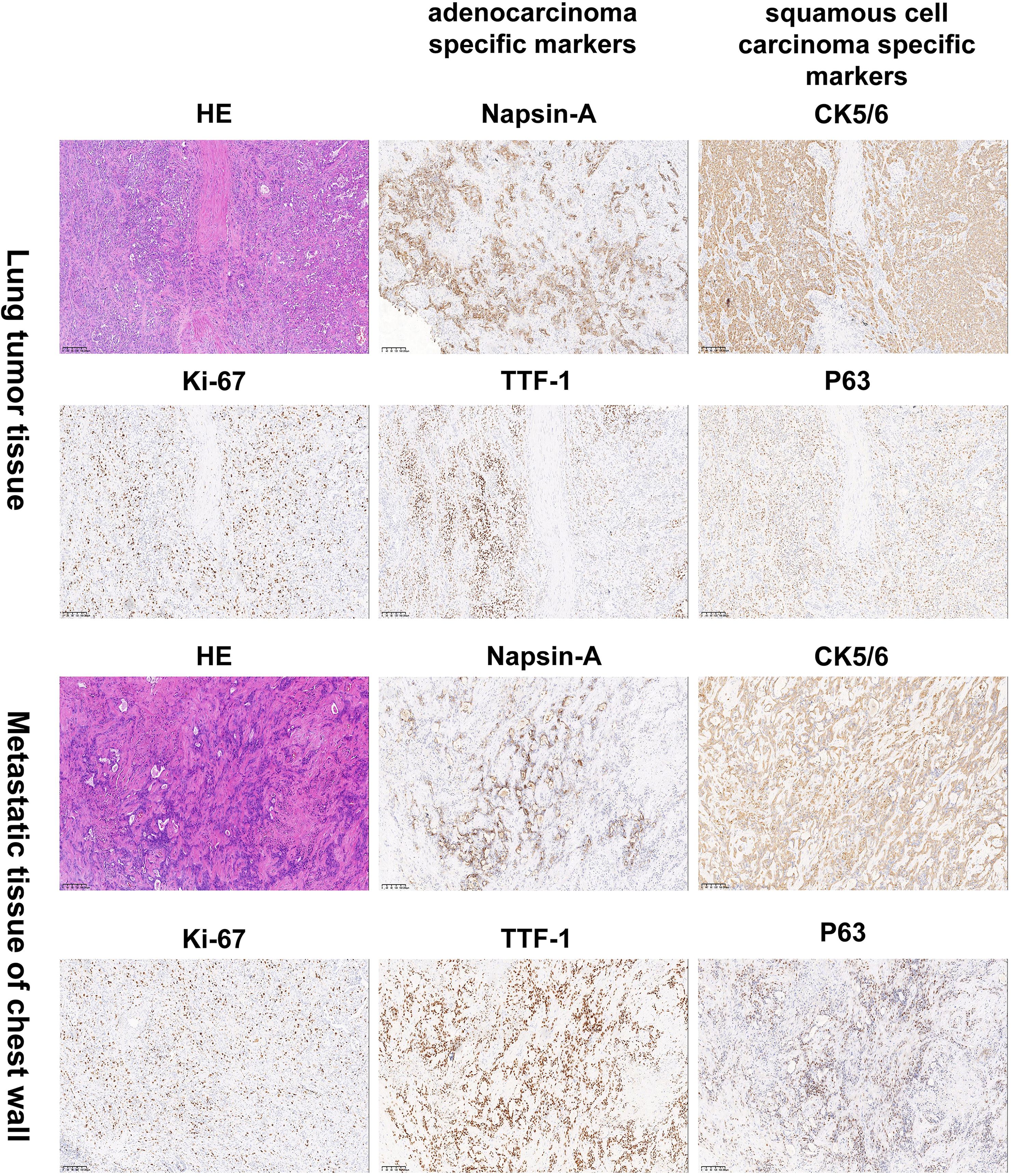 Microscopic images of lung tumor and metastatic chest wall tissues showing adrenocarcinoma markers (Napsin-A, TTF-1) and squamous cell carcinoma markers (CK5/6, P63) with HE and Ki-67 staining.