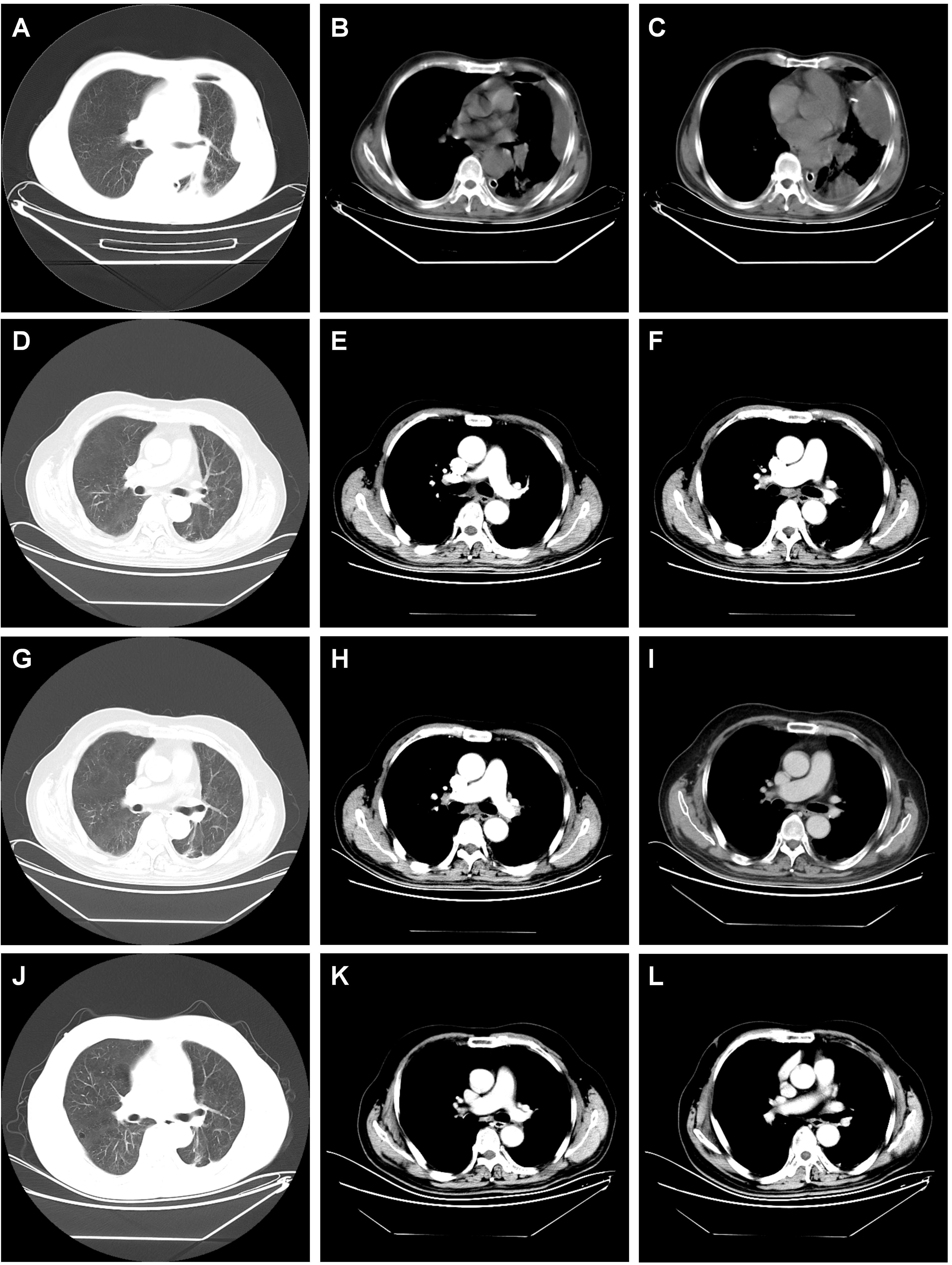 Twelve CT scan images arranged in a grid, labeled A to L. Each image shows different cross-sectional views of the thorax, highlighting various structures like lungs and heart. Images depict different levels of contrast and anatomical detail.