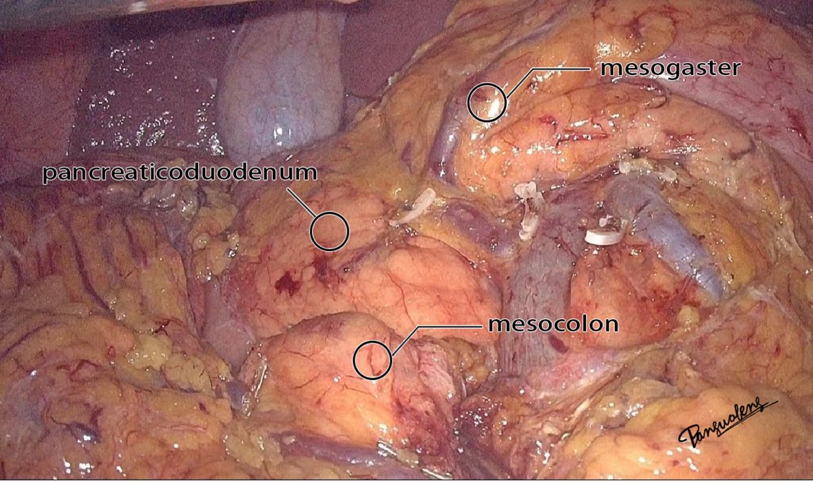 Surgical image highlighting anatomical structures labeled as pancreatoduodenum, mesogaster, and mesocolon in a human body. The labels point to specific areas of exposed and marked tissue, displaying surgical annotations.