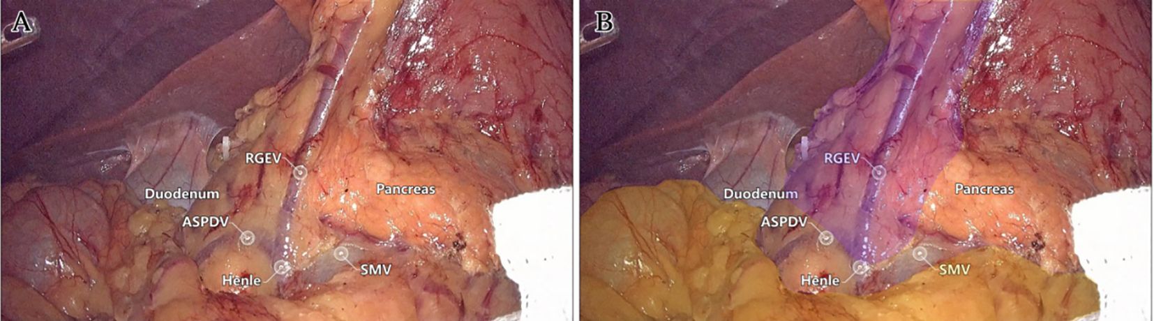 Two medical images labeled A and B show abdominal anatomy, featuring structures like the pancreas, duodenum, and associated veins such as RGEV, ASPDV, and SMV. The images highlight different visual aspects of these organs and vessels.
