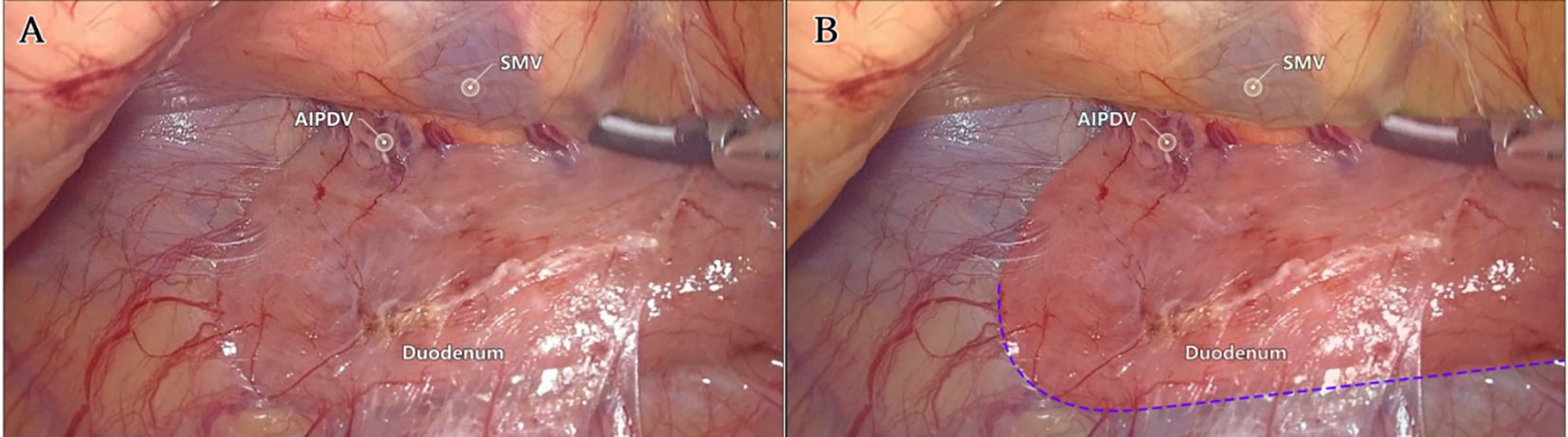 Two images labeled A and B depict a surgical view of the abdominal cavity. Both images show the duodenum, with labels identifying the anterior inferior pancreaticoduodenal vein (AIPDV) and the superior mesenteric vein (SMV). Image B includes a blue dashed line marking a section of interest.