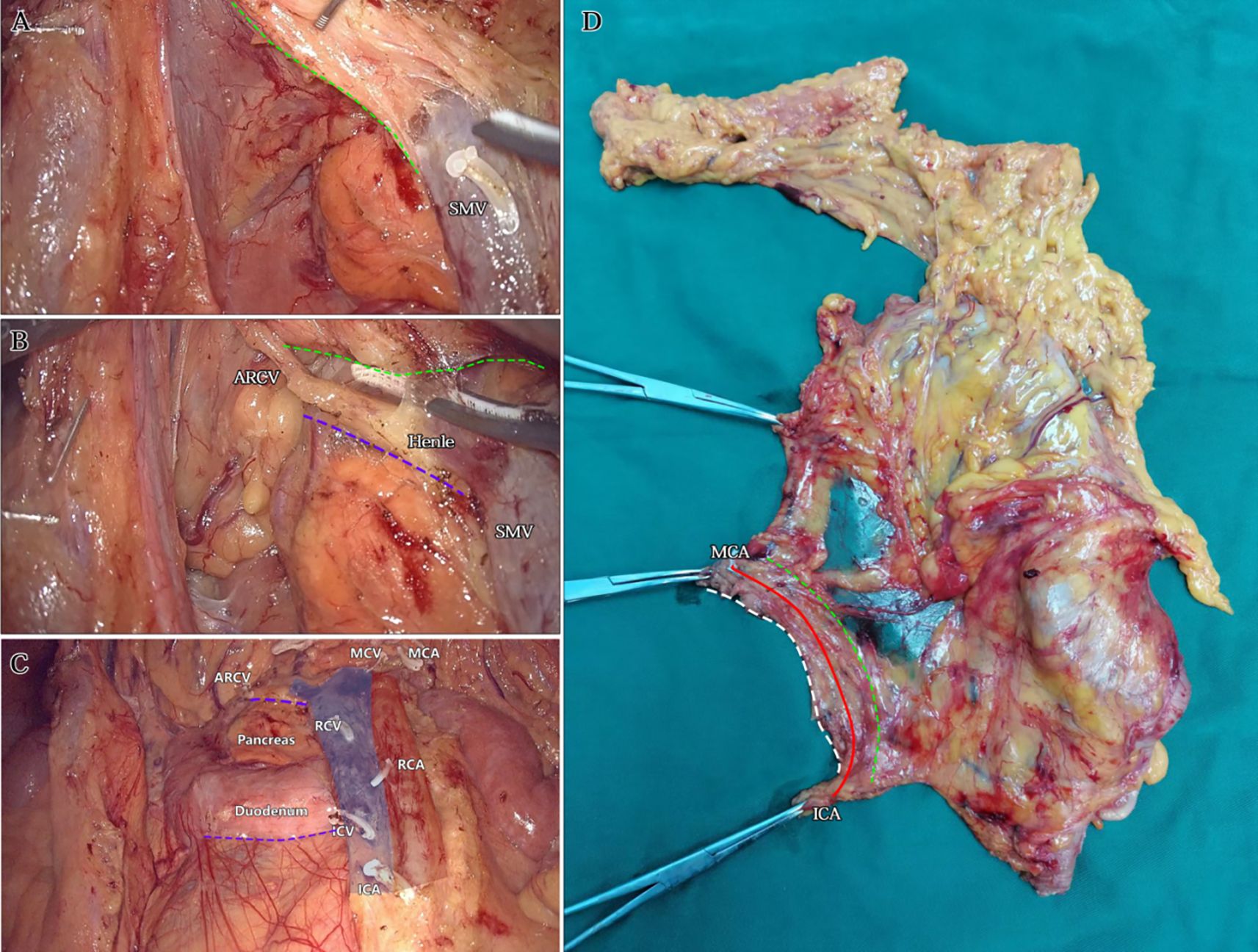 Four-panel image showcasing surgical views and an extracted specimen related to abdominal anatomy. Panel A shows the SMV with an instrument. Panel B highlights the ARGV, Henle's trunk, and SMV. Panel C delineates structures including the ARCv, pancreas, duodenum, and various veins and arteries. Panel D presents the extracted specimen showing anatomical structures like the MCA and ICA against a teal background.
