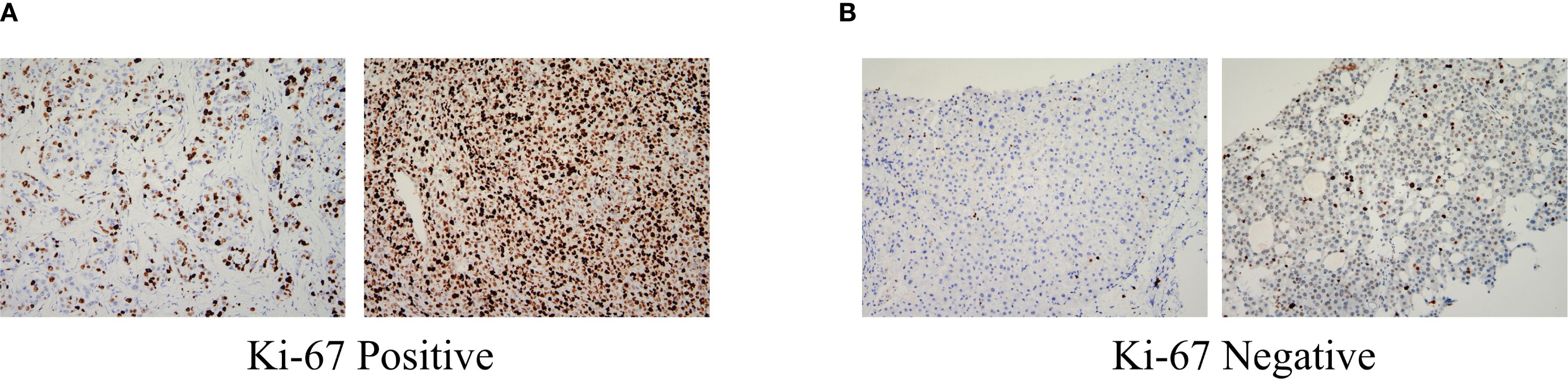 Panel A shows two images of tissue samples with Ki-67 positive staining, featuring numerous brown-stained cells indicating high proliferation. Panel B shows two images of Ki-67 negative staining with fewer brown-stained cells, indicating low proliferation.