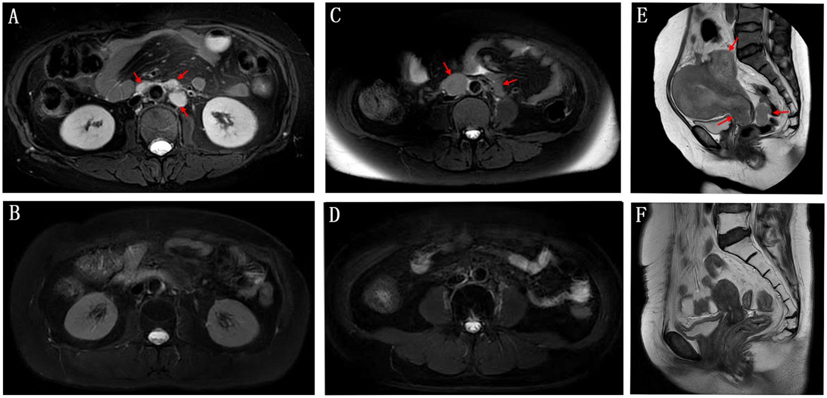 Six MRI scans show cross-sectional and sagittal views of the abdominal region. Panels A, C, and E highlight specific areas with red arrows, indicating abnormalities or features of interest. Panels B, D, and F show similar anatomical views without highlights. Each panel represents different planes and aspects, emphasizing organ structures and tissues.